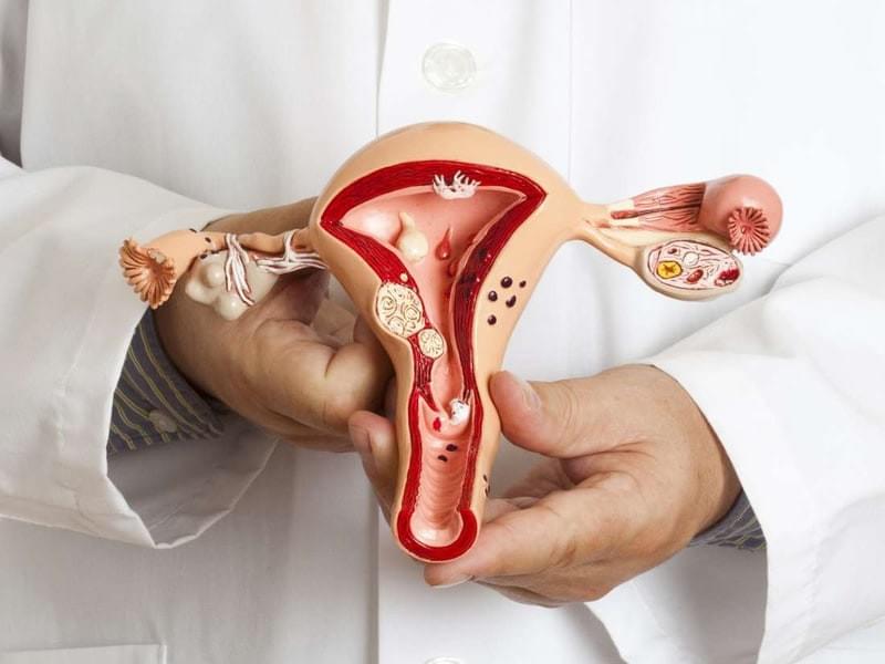 Hình ảnh viêm vùng chậu gây ứa dịch vòi trứng Hình ảnh viêm vùng chậu gây ứa dịch vòi trứng