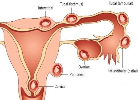 Hình ảnh viêm vùng chậu biến chứng gây thai ngoài tử cung Hình ảnh viêm vùng chậu biến chứng gây thai ngoài tử cung