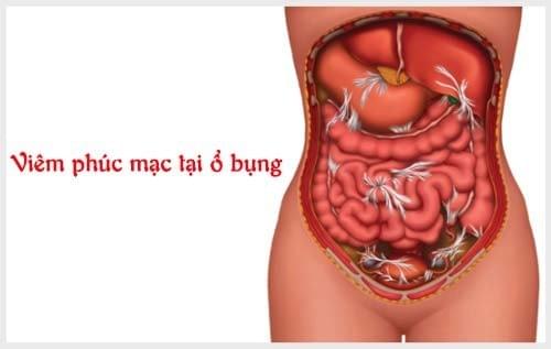 hình ảnh viêm vùng chậu biến chứng gây viêm phúc mạc ổ bụng hình ảnh viêm vùng chậu biến chứng gây viêm phúc mạc ổ bụng