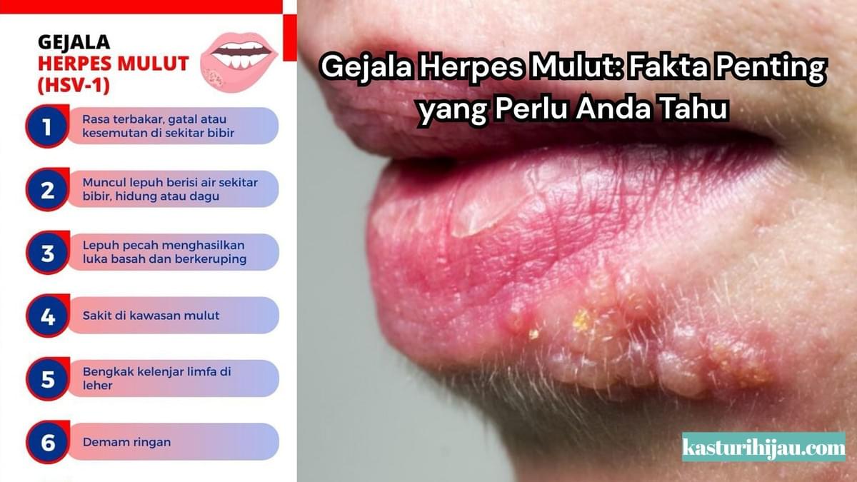Gejala Herpes Mulut: Fakta Penting yang Perlu Anda Tahu Gejala Herpes Mulut: Fakta Penting yang Perlu Anda Tahu