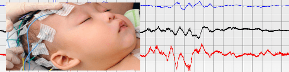 Cork AI Meetup 2 - Deep Learning for analysis of brain-waves of newborn infants Cork AI Meetup 2 - Deep Learning for analysis of brain-waves of newborn infants