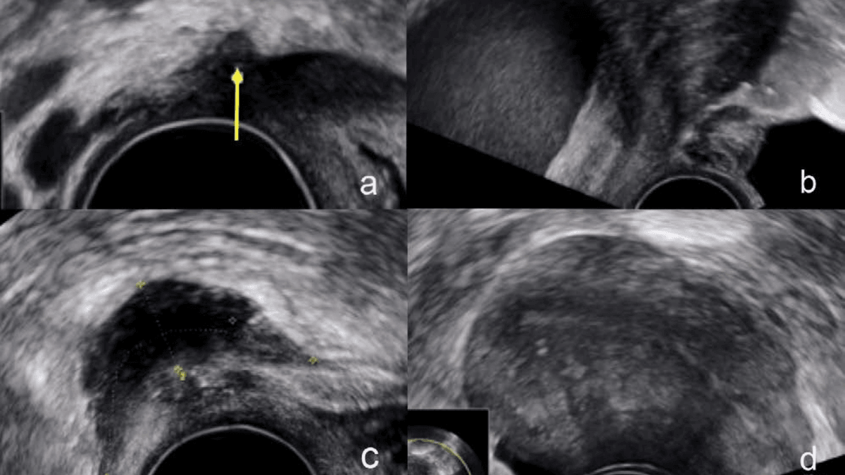 Ultraschall-Bilder von Endometriose Ultraschall-Bilder von Endometriose