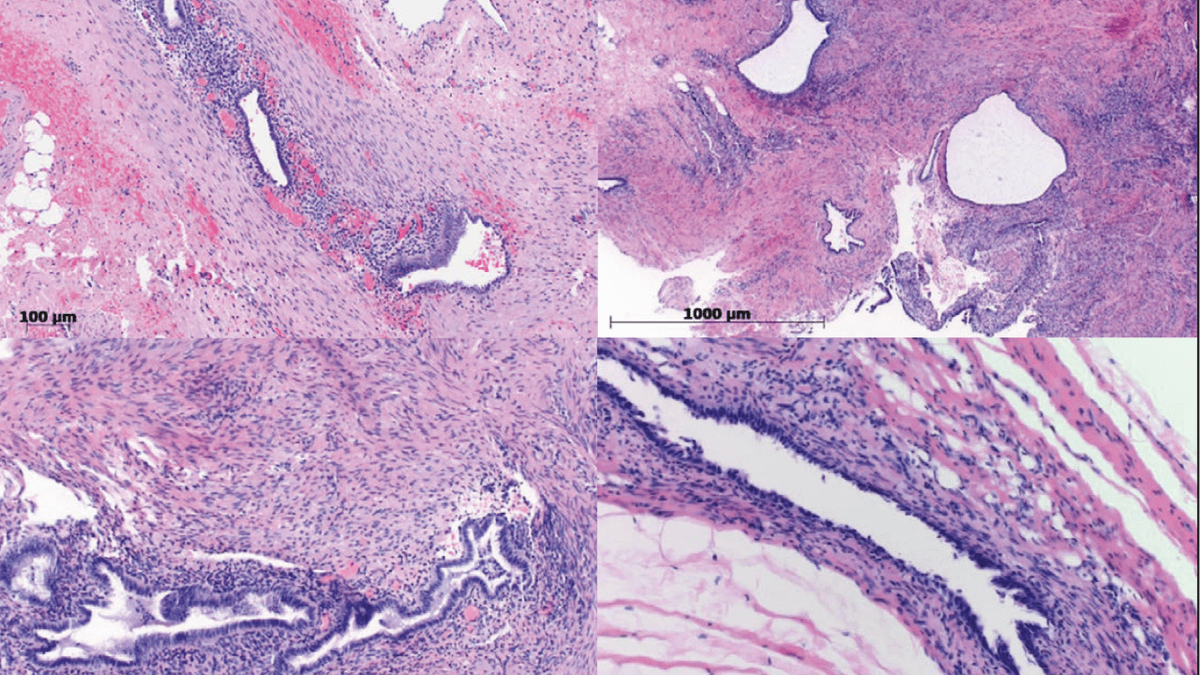 Bilder von Endometriose unter dem Mikroskop Bilder von Endometriose unter dem Mikroskop