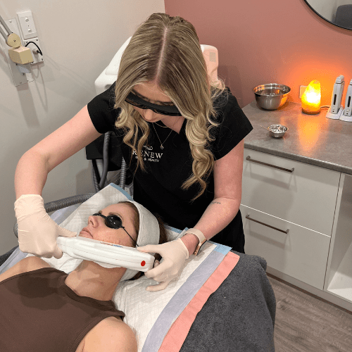 IPL Skin Rejuvination IPL Skin Rejuvination