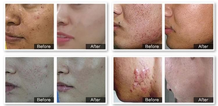 Vertical Fractional CO2 Laser Skin Care System