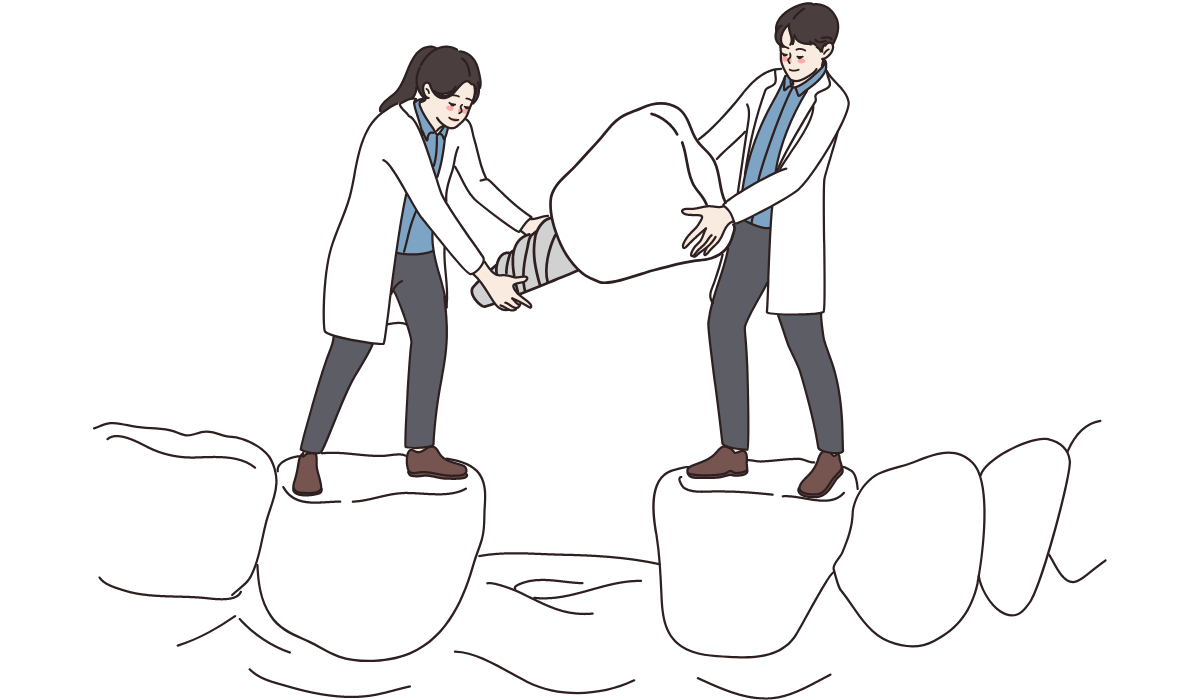 All-on-4術後怎麼清潔 All-on-4術後怎麼清潔