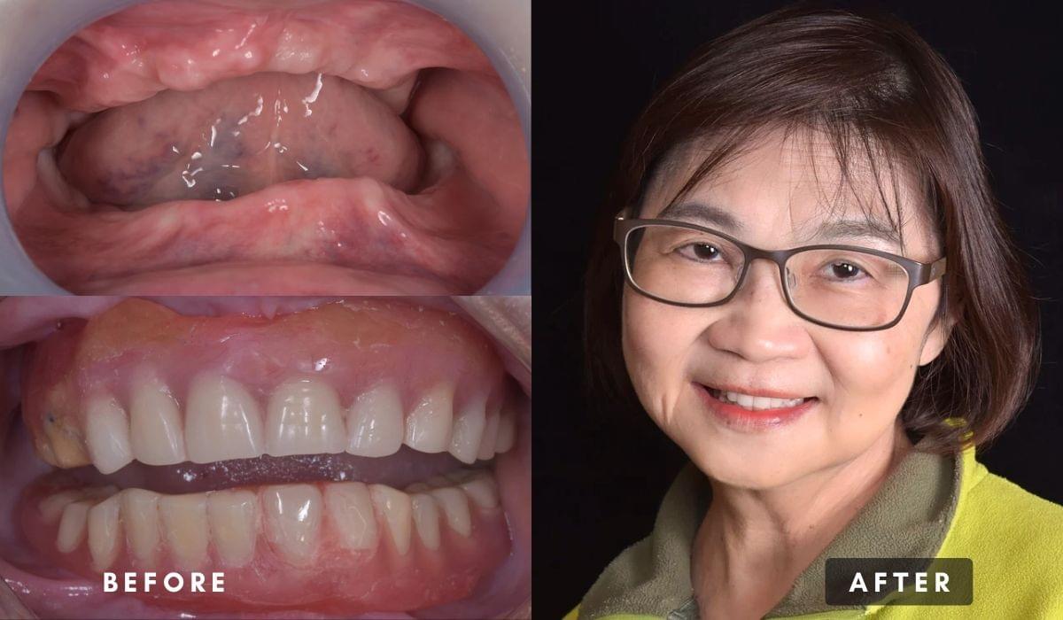 新北中和均潔牙醫診所,吸附式活動假牙推薦案例 新北中和均潔牙醫診所,吸附式活動假牙推薦案例