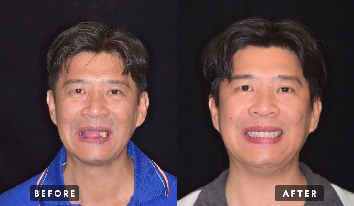 新北中和均潔牙醫診所,吸附式活動假牙推薦案例 新北中和均潔牙醫診所,吸附式活動假牙推薦案例