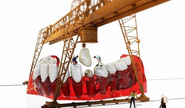 植牙術後保養 植牙術後保養