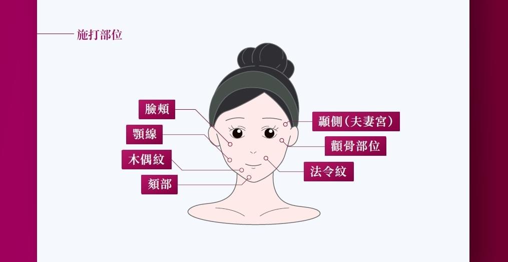 4D舒顏萃可施打部位,有 臉頰、顎線、木偶紋、頰部、夫妻宮、顴骨部位、法令紋 4D舒顏萃可施打部位,有 臉頰、顎線、木偶紋、頰部、夫妻宮、顴骨部位、法令紋
