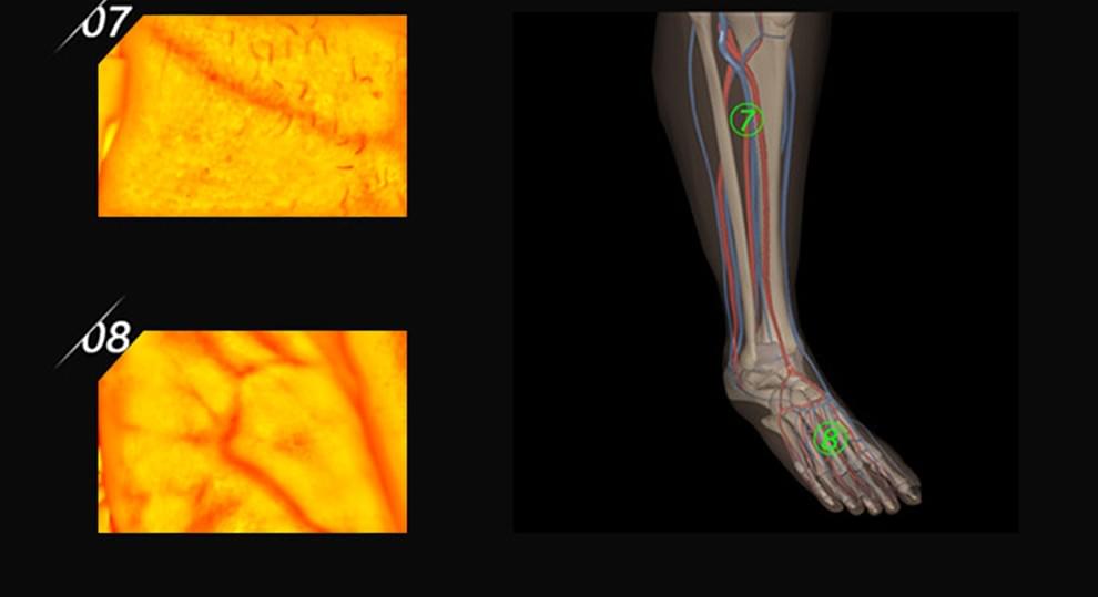 ZY500 Computer-Based Infrared Vein Finder