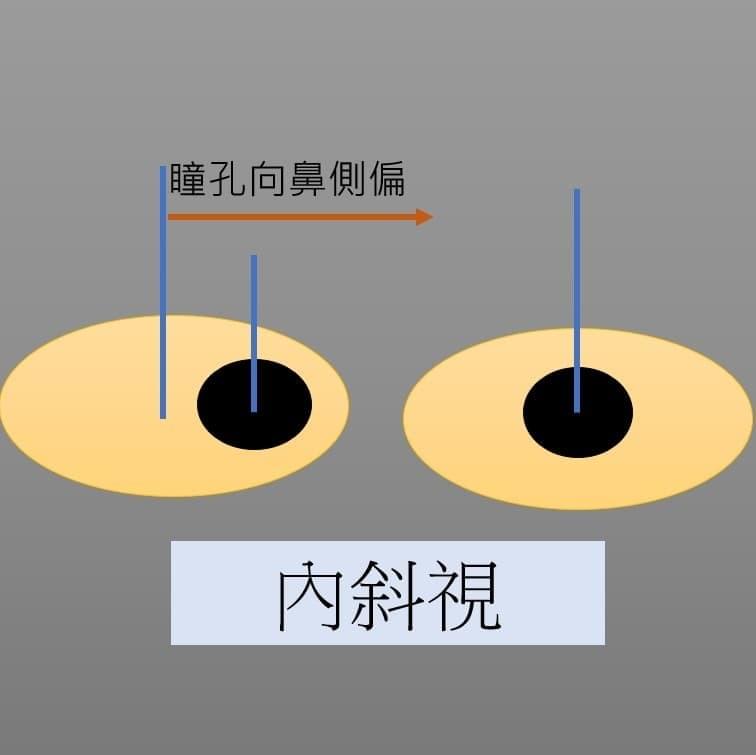 斜視/內斜視 斜視/內斜視