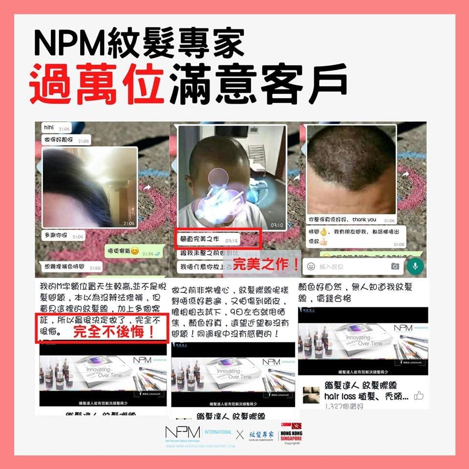 NPM纹发线/纹发际线 NPM纹发线/纹发际线