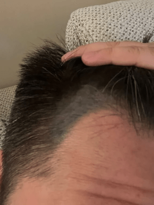 SMP紋髮 紋髮失敗個案 SMP紋髮 紋髮失敗個案