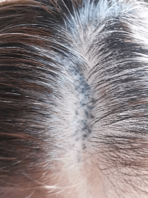 SMP紋髮 紋髮失敗個案 SMP紋髮 紋髮失敗個案