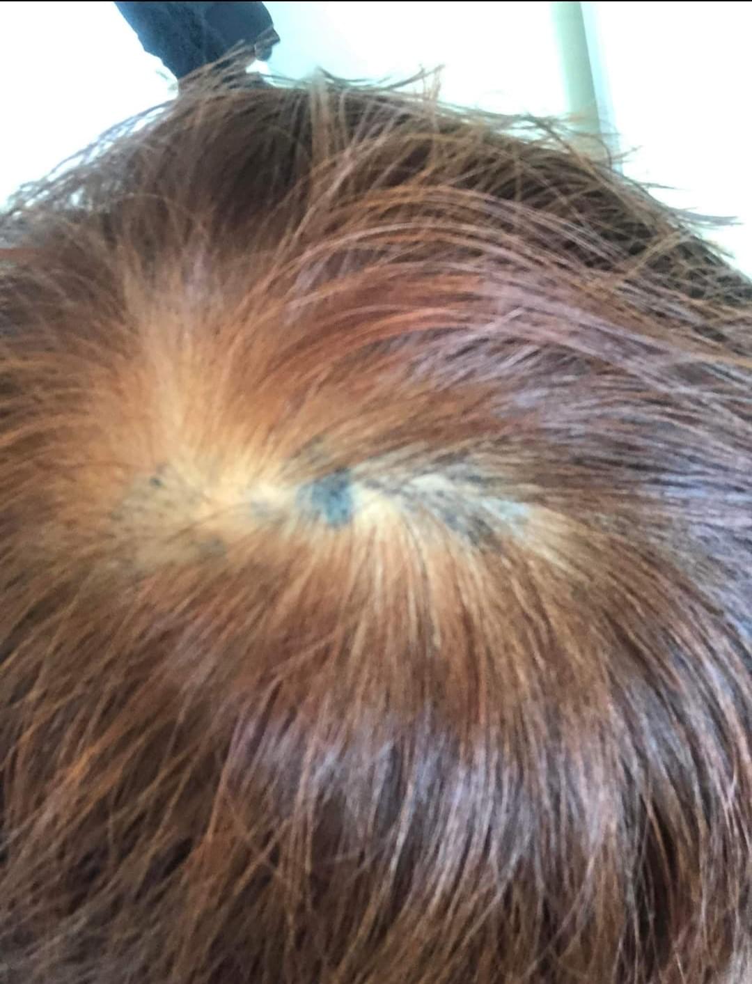 SMP紋髮 紋髮失敗個案 SMP紋髮 紋髮失敗個案