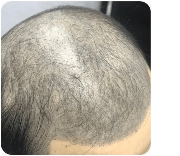 SMP紋髮 紋髮失敗個案 SMP紋髮 紋髮失敗個案