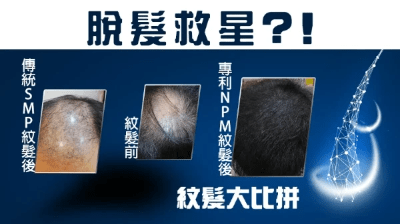 【脫髮】解構紋髮技術 專利NPM紋髮 VS 傳統SMP紋髮 【脫髮】解構紋髮技術 專利NPM紋髮 VS 傳統SMP紋髮