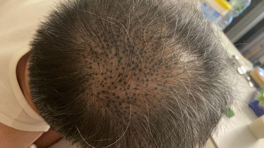 SMP紋髮 紋髮失敗個案 SMP紋髮 紋髮失敗個案