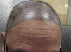 SMP紋髮 紋髮失敗個案 SMP紋髮 紋髮失敗個案