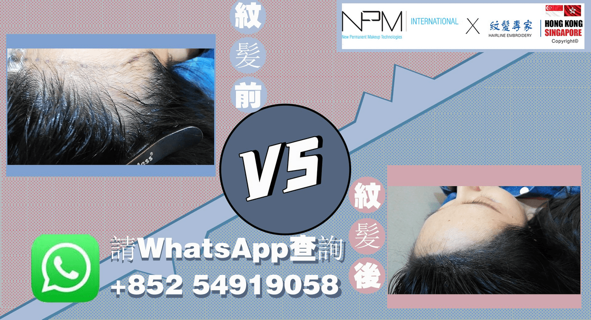 香港紋髮價目表 NPM 紋髮/紋頭皮/紋髮際線/頭皮模擬毛囊技術(HFS) 香港紋髮價目表 NPM 紋髮/紋頭皮/紋髮際線/頭皮模擬毛囊技術(HFS)