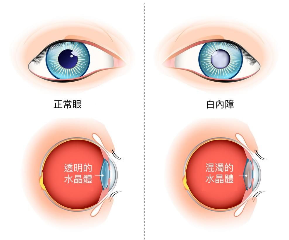 白內障外觀 白內障外觀