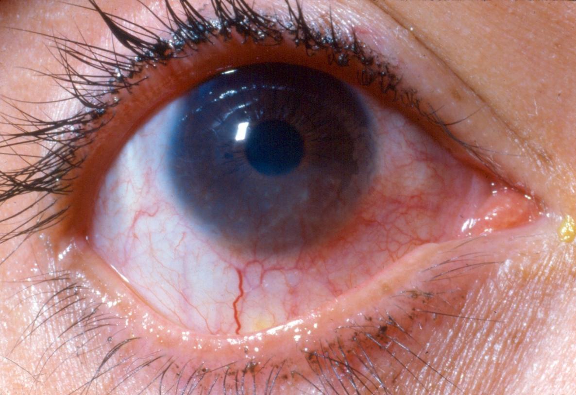 eye diseases eye diseases
