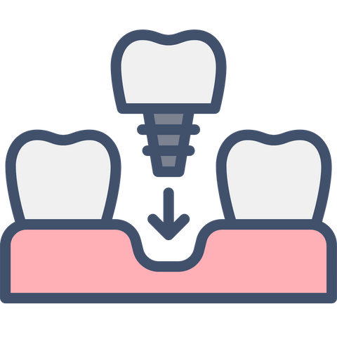 數位導引植牙 數位導引植牙