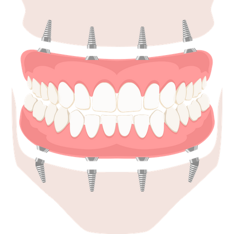 All-on-4/6一日全口重建 All-on-4/6一日全口重建