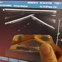 3D ultrasound: simulated wrist fracture