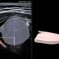 3D ultrasound: dysplastic hip