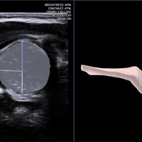 3D ultrasound: normal hip
