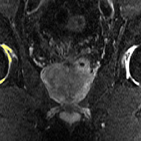 Semi-automated quantification of joint effusion