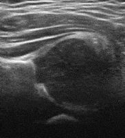 Normal hip - 3D ultrasound
