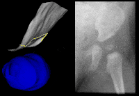 Dysplastic hip - Xray and utrasound