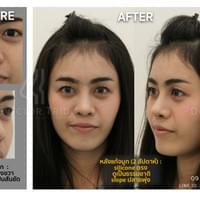 แก้จมูก เสริมจมูก กาญจนบุรี