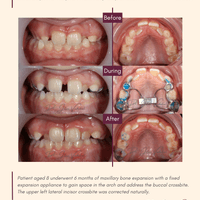 Narrowing of the maxilla (upper jaw) causing crowding and crossbite. Treated with a fixed expansion appliance.