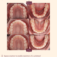 A growing child treated with clear aligner therapy to broaden arches, enabling space to align teeth and optimise arches