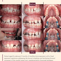 A narrowed upper jaw combined with crossbites at the front and back of the mouth, treated with facemask protraction RME