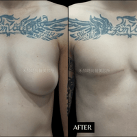 一字型平胸手術案例