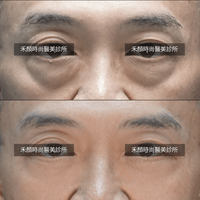 眼袋術前術後案例