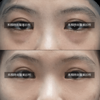 眼袋術前術後案例