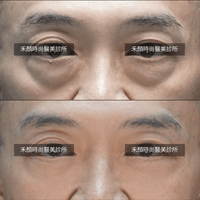 眼袋案例圖片