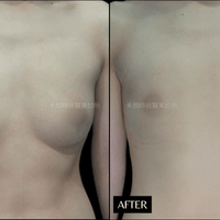 乳暈型平胸手術案例