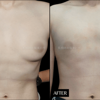 乳暈型平胸手術案例