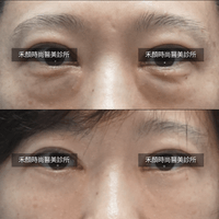 眼袋術前術後案例