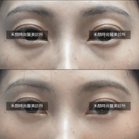 眼袋術前術後案例