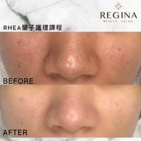 藻針  清粉刺  美容煥膚  肌膚健康養成  透白  零毛孔  痘痘剋星  坑洞救星  痘疤淡化 幹細胞科技  維珍娜藻針  安平做臉  台南清粉刺  台南做臉  無痛清粉刺  台南美容 台南做臉推薦  臉部雕塑  台南清痘痘  婚前保養