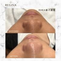 藻針  清粉刺  美容煥膚  肌膚健康養成  透白  零毛孔  痘痘剋星  坑洞救星  痘疤淡化 幹細胞科技  維珍娜藻針  安平做臉  台南清粉刺  台南做臉  無痛清粉刺  台南美容 台南做臉推薦  臉部雕塑  台南清痘痘  婚前保養