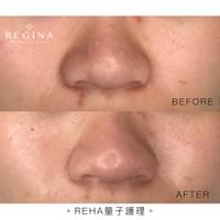 藻針  清粉刺  美容煥膚  肌膚健康養成  透白  零毛孔  痘痘剋星  坑洞救星  痘疤淡化 幹細胞科技  維珍娜藻針  安平做臉  台南清粉刺  台南做臉  無痛清粉刺  台南美容 台南做臉推薦  臉部雕塑  台南清痘痘  婚前保養